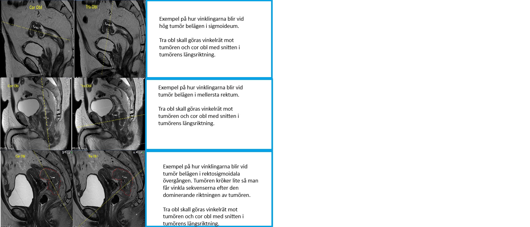     Olika exempel på hur Cor Obl resp Tra Obl ska vinklas beroende på var tumören är lokaliserad. 